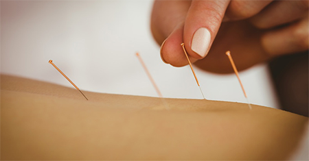 acupuncture